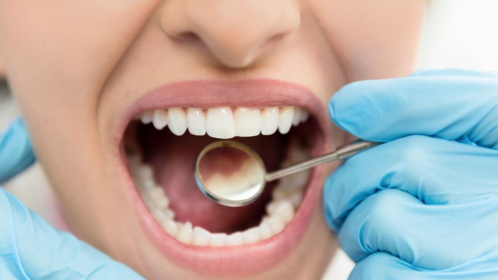 بهداشت ضعیف دهان و دندان موجب تشدید بیماری التهاب روده می شود