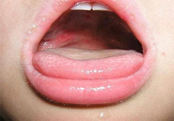 «بثورات دهان» علامت دیگر بیماری کووید۱۹